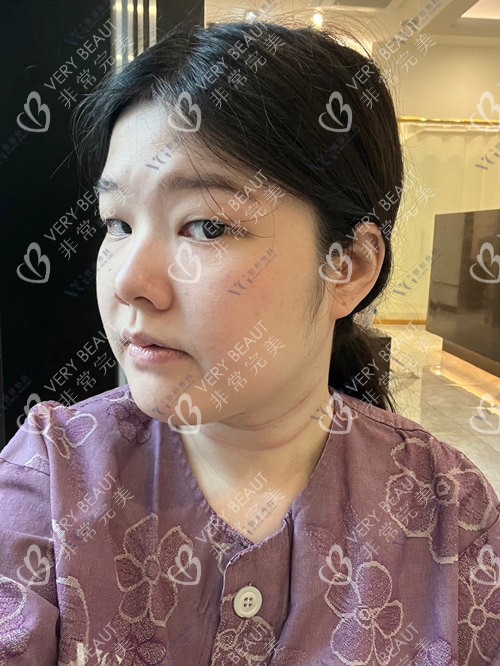 韓國VG整形外科術(shù)前側(cè)面