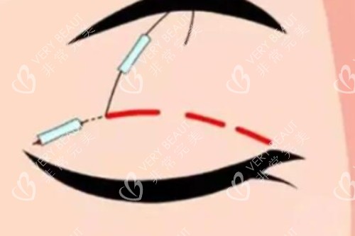 埋線雙眼皮卡通圖