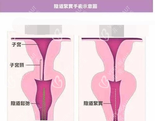 女生小手术下面图片