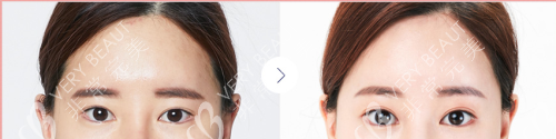 韓國大眼睛整形醫(yī)院眼整形前后