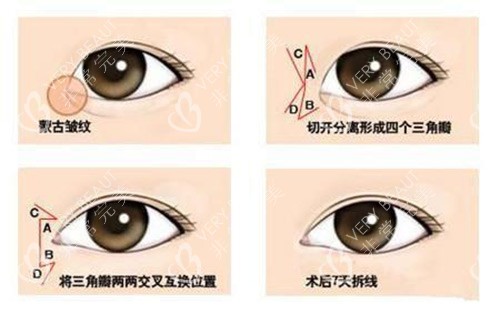 眼整形示意圖