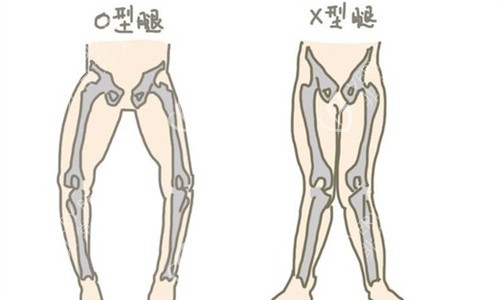 變形腿型展示圖