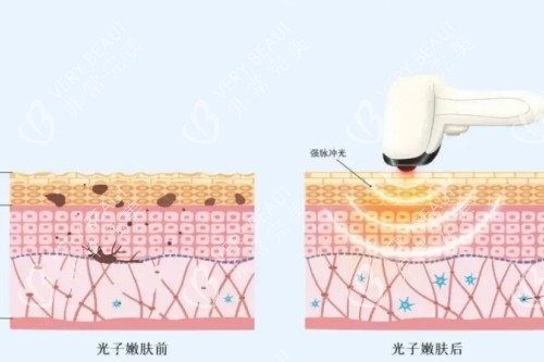 光子嫩膚治療原理圖