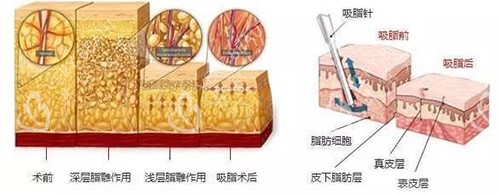 面部吸脂示意圖