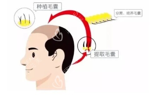 植发的示意图