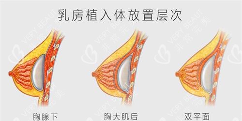 假體隆胸植入位置