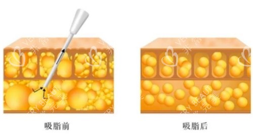 吸脂前后展示圖