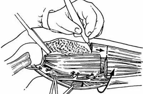 小腿肌肉手術(shù)卡通示意圖