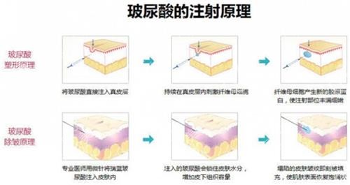 玻尿酸注射原理