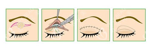 埋线双眼皮示意图图片