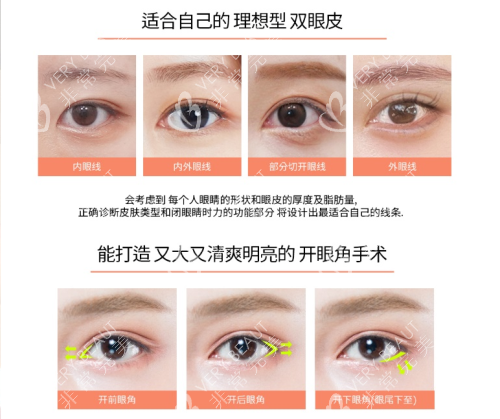 韓國(guó)褔萊澤pleasure整形外科雙眼皮示意圖