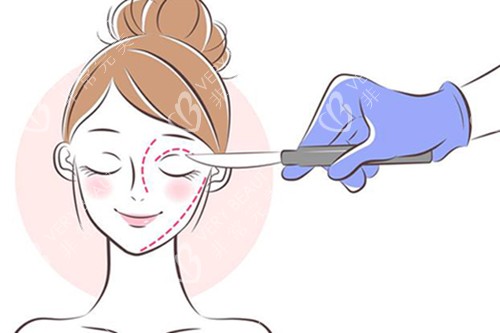 听说削骨整形已经不流行了!面部轮廓固定成整圈新宠~-非常完美