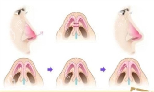 假体隆鼻流程