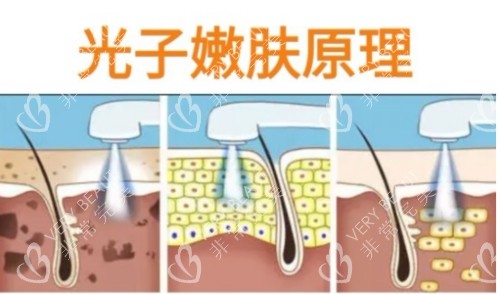 光子嫩膚原理圖