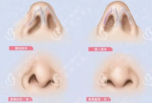 鼻翼緣缺損示意圖