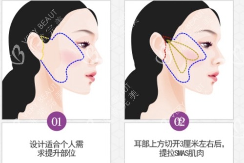 韓國(guó)必當(dāng)歸醫(yī)院QMC提升示意圖
