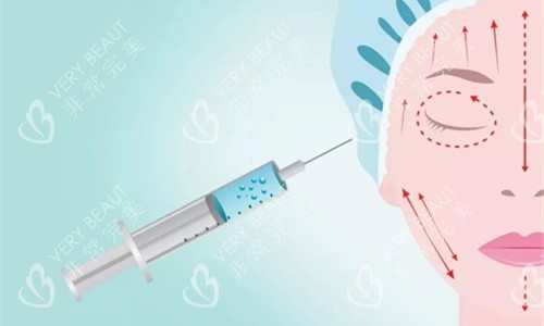 玻尿酸面部注射图