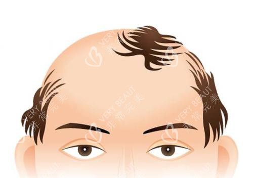 脫發(fā)禿頂動(dòng)畫(huà)示意圖