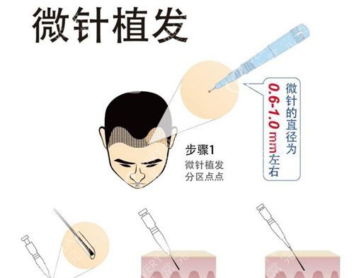 微針植發(fā)步驟示意圖