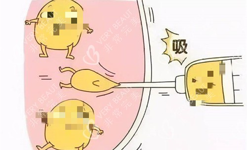 吸脂卡通图