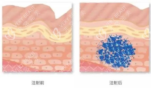 玻尿酸注射前后示意图