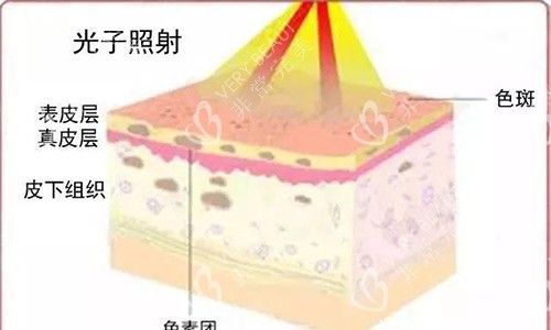 光子嫩肤原理示意图