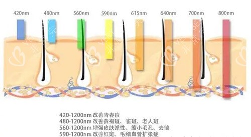 光子嫩肤治疗示意图
