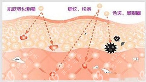 光子嫩肤过程示意图
