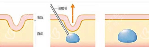 淚溝去除示意圖