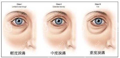 淚溝程度示意圖