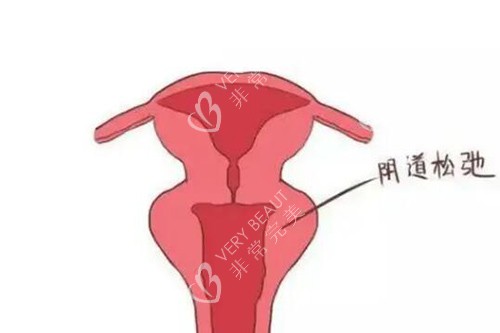 阴道松弛卡通图示意