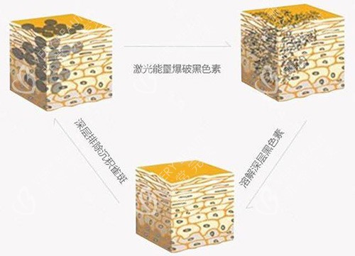 祛斑示意图 祛斑示意图