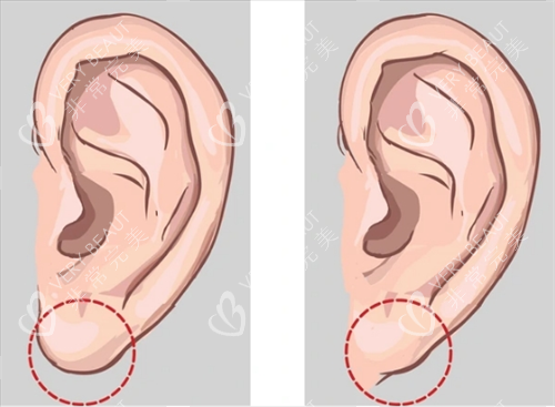 有无耳垂对比图片