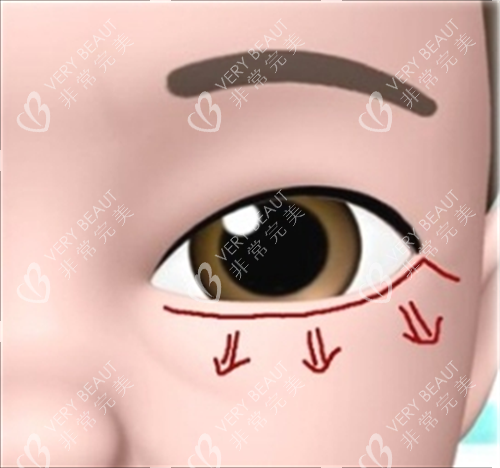 眼部施术切口展示素材