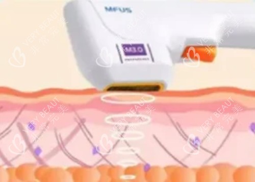 超声炮面部美容卡通示意图 超声炮面部美容卡通示意图