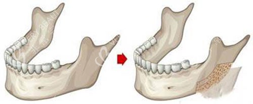 轮廓 下颌角示意图