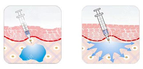 法令纹填充示意图 法令纹填充示意图