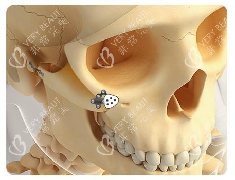 45度侧颧骨缩小