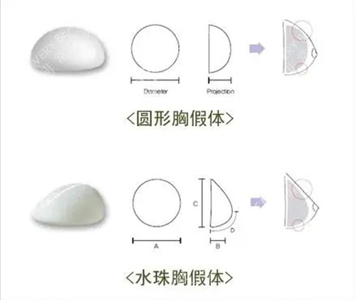 丰胸手术曼托圆形及水滴形假体植入成效示意图