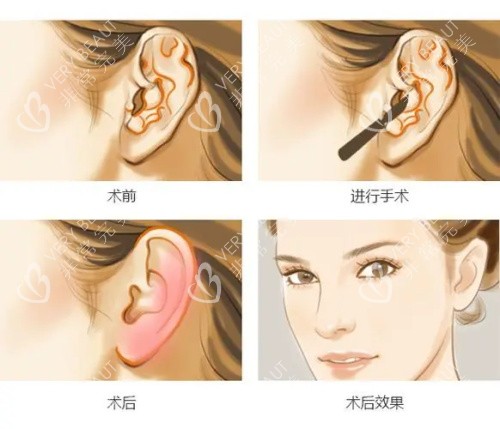 耳整形手术步骤