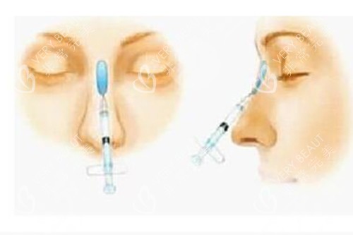 玻尿酸美容填充鼻梁示意图