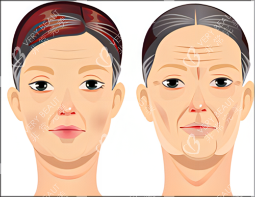 面部后期衰老下垂示例图