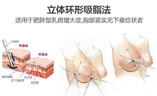 立体环形吸脂法缩小乳房示意图 立体环形吸脂法缩小乳房示意图