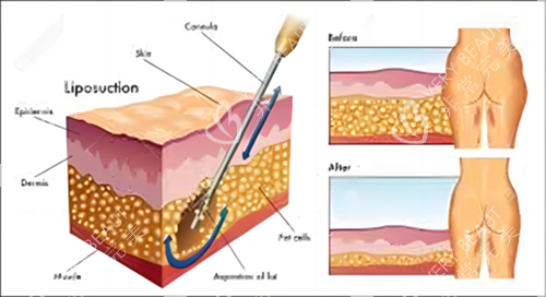 吸脂前后对比素材