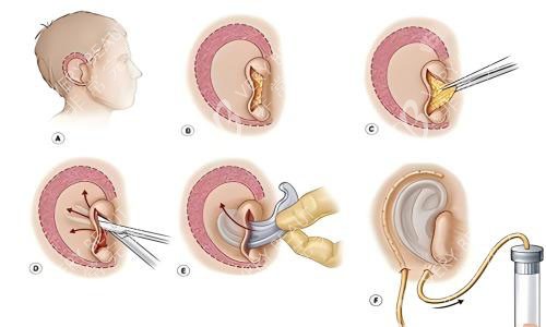 耳再造手术动画图