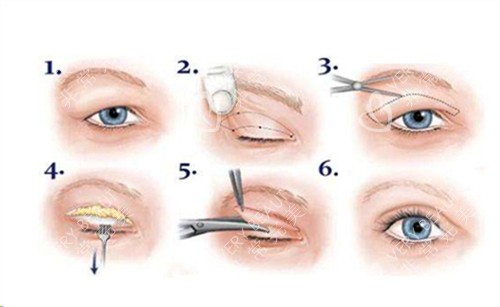 全切双眼皮手术流程卡通示例图