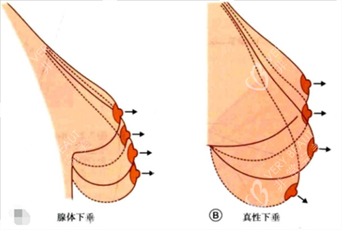 胸部提升素材