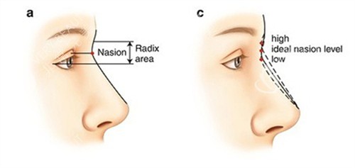 隆鼻手术术前术后设计图