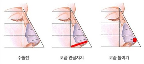 隆鼻手术前后方法示例图