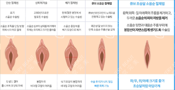 私密手术操作示意图